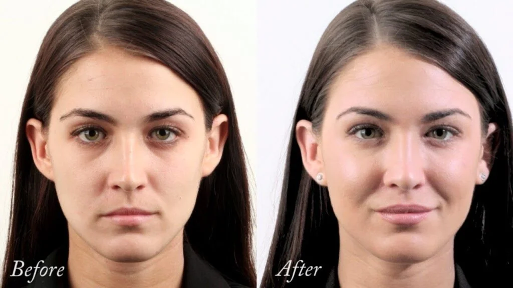 Cheek Filler Before And After: What To Expect