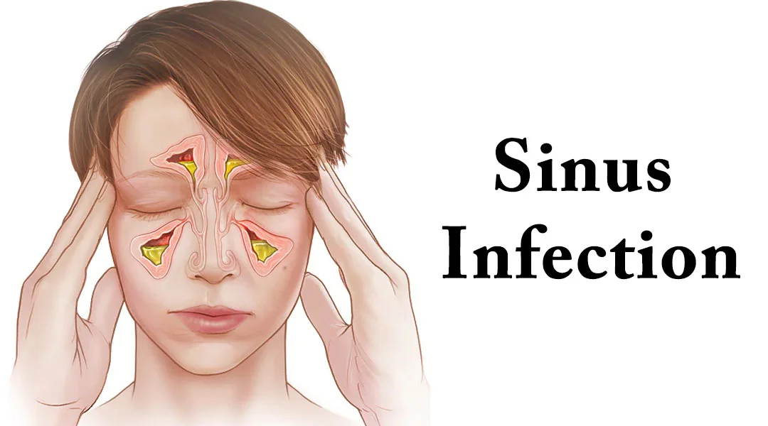 Are Sinus Infections Contagious?