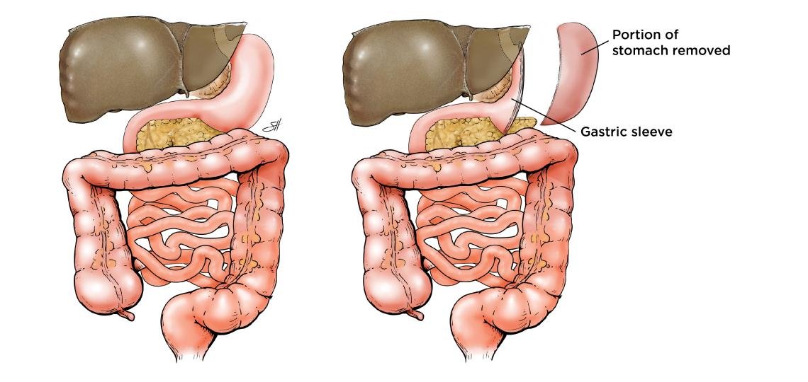 Gastric sleeve surgery